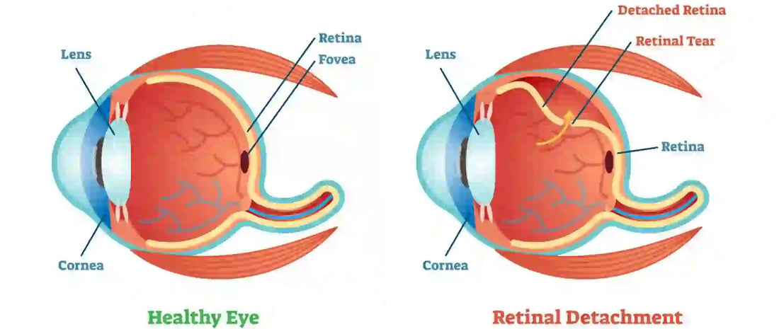 What is Retinal Detachment?